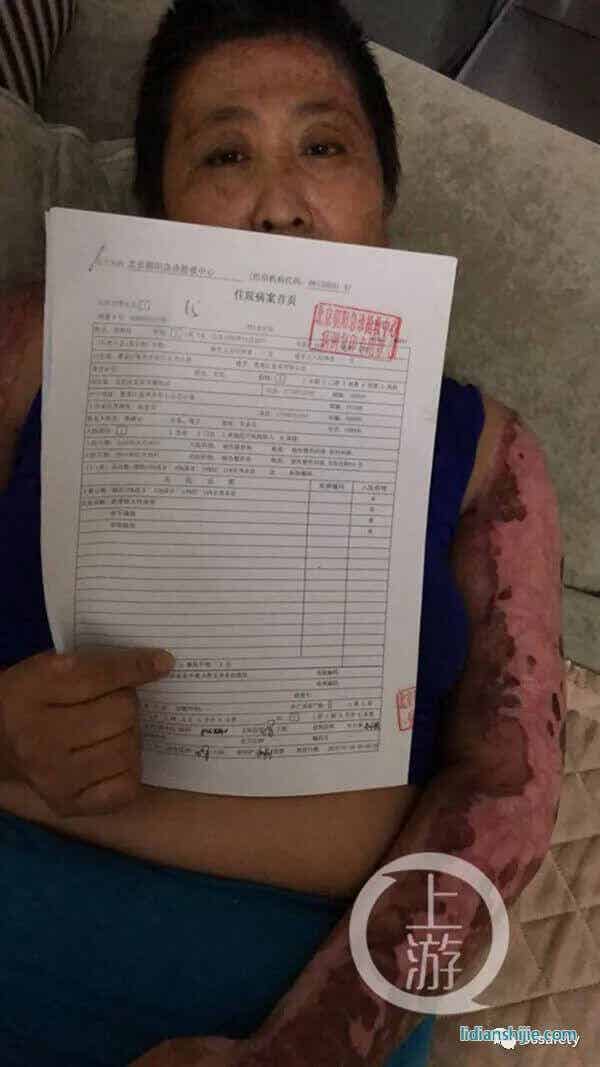 爆燃的電動車鋰電池傷害